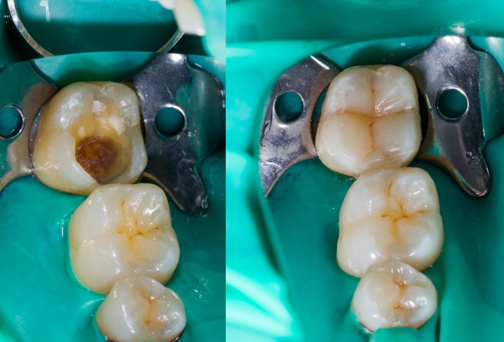 Before and After - Composite Resin Fillings