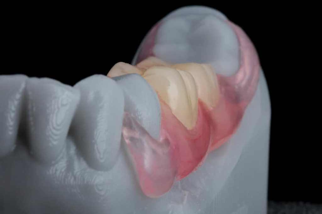 Flexible Valplast Dentures